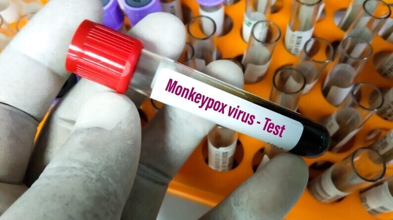 The first case of monkeypox was confirmed in Ukraine